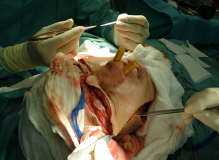 Illustration for article titled Reddit User Documents Facial Transplant in Photos (WARNING: GRAPHIC)